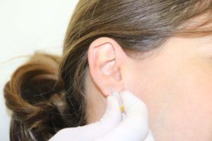 Acupuntura permanente