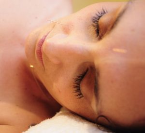 acupuntura en Valencia