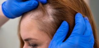 injerto-capilar-