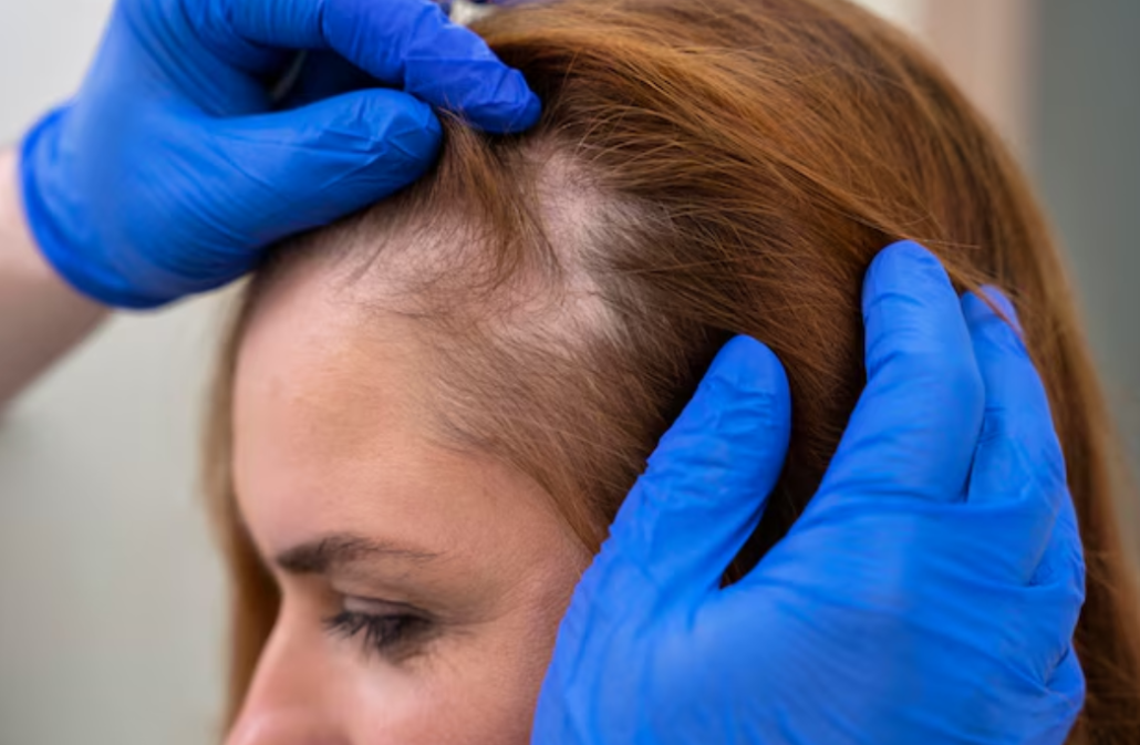 injerto-capilar-