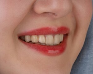 carillas dentales
